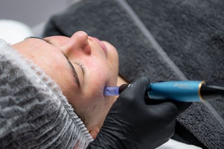 Microneedling Bern, Anti Aging Bern