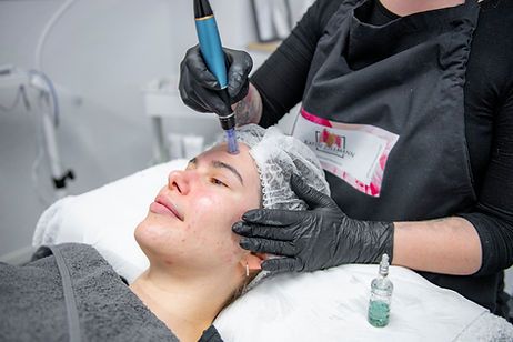 Microneedling Bern