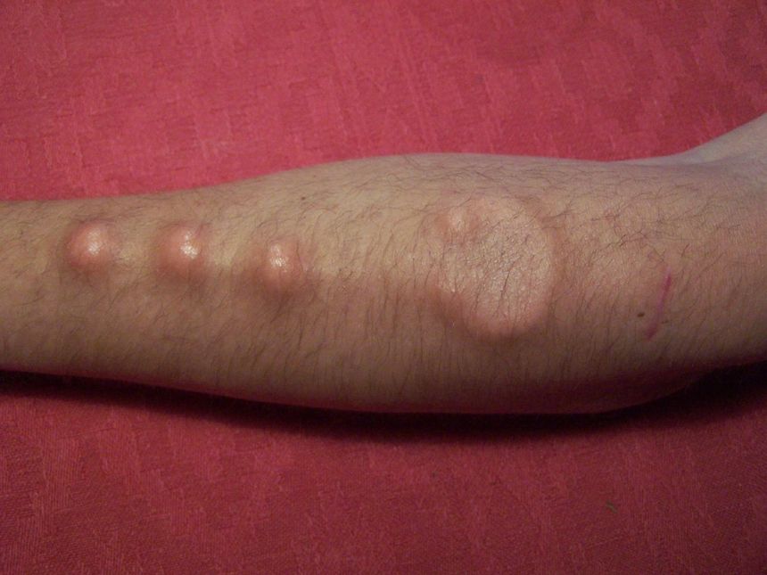 Arm with raised, red, circular welts, possibly from insect bites or allergic reaction, on red background.