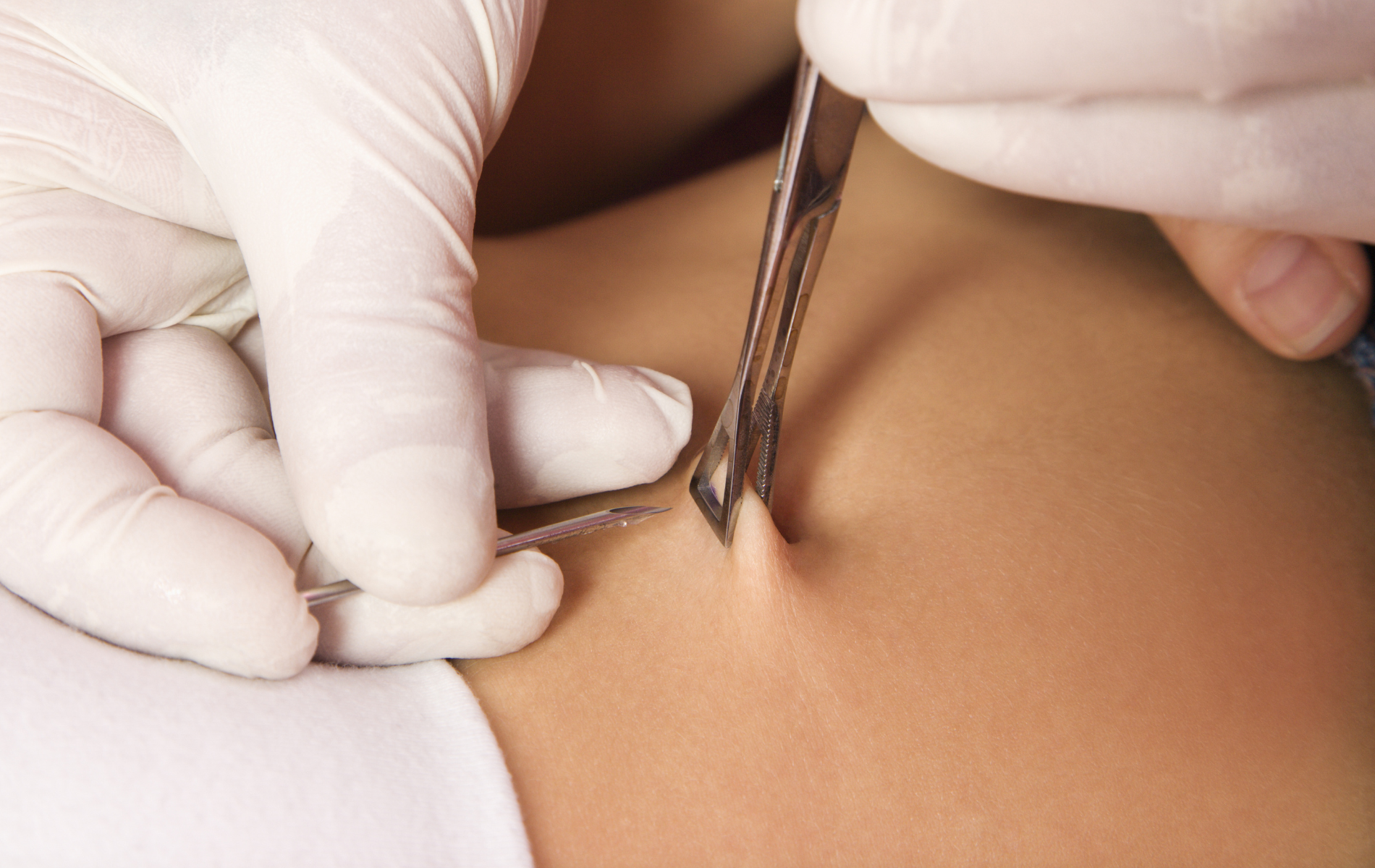 Gloved hands using surgical instrument on skin.