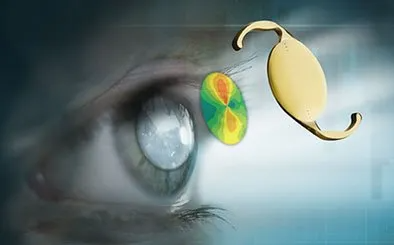 CATARACT SURGERY