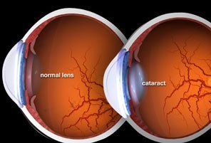 Best cataract surgery bangalore
