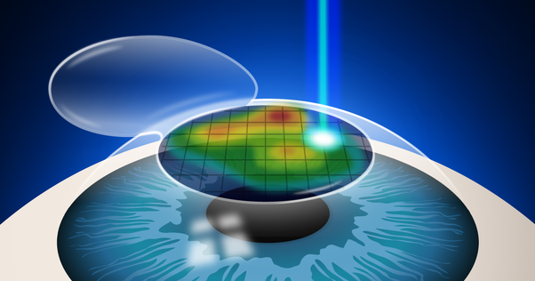 REFRACTIVE   SERVICES
