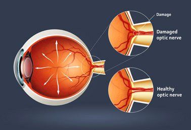 Glaucoma eye care bangalore