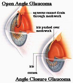 Glaucoma eye surgery bangalore