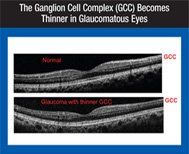 Glaucoma eye hospital bangalore