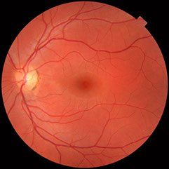 best retina eye hospital bangalore