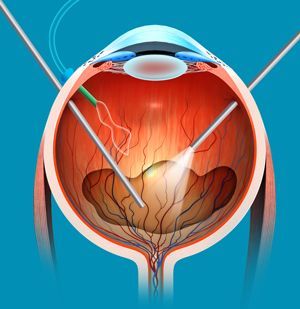 VITREO - RETINA SERVICES