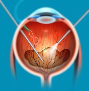 VITREO-RETINA  SERVICES