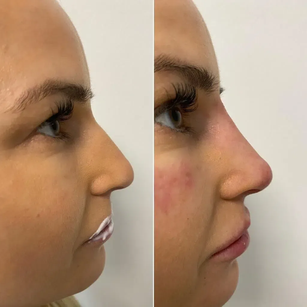 Ein Vorher-Nachher-Foto der Nase einer Frau.