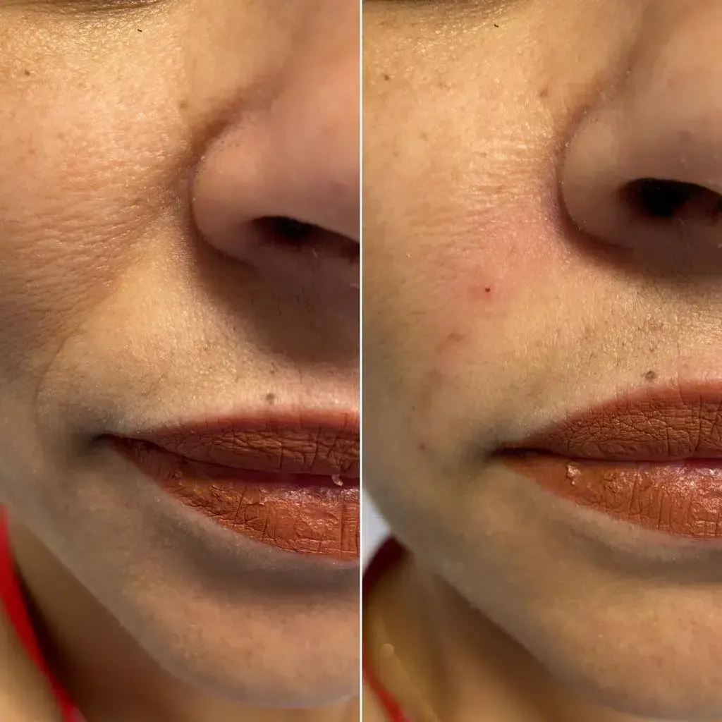 Ein Vorher-Nachher-Foto vom Gesicht und den Lippen einer Frau.