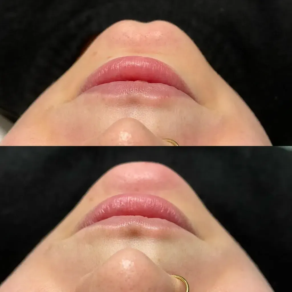 Die Lippen einer Frau werden vor und nach einer Behandlung gezeigt