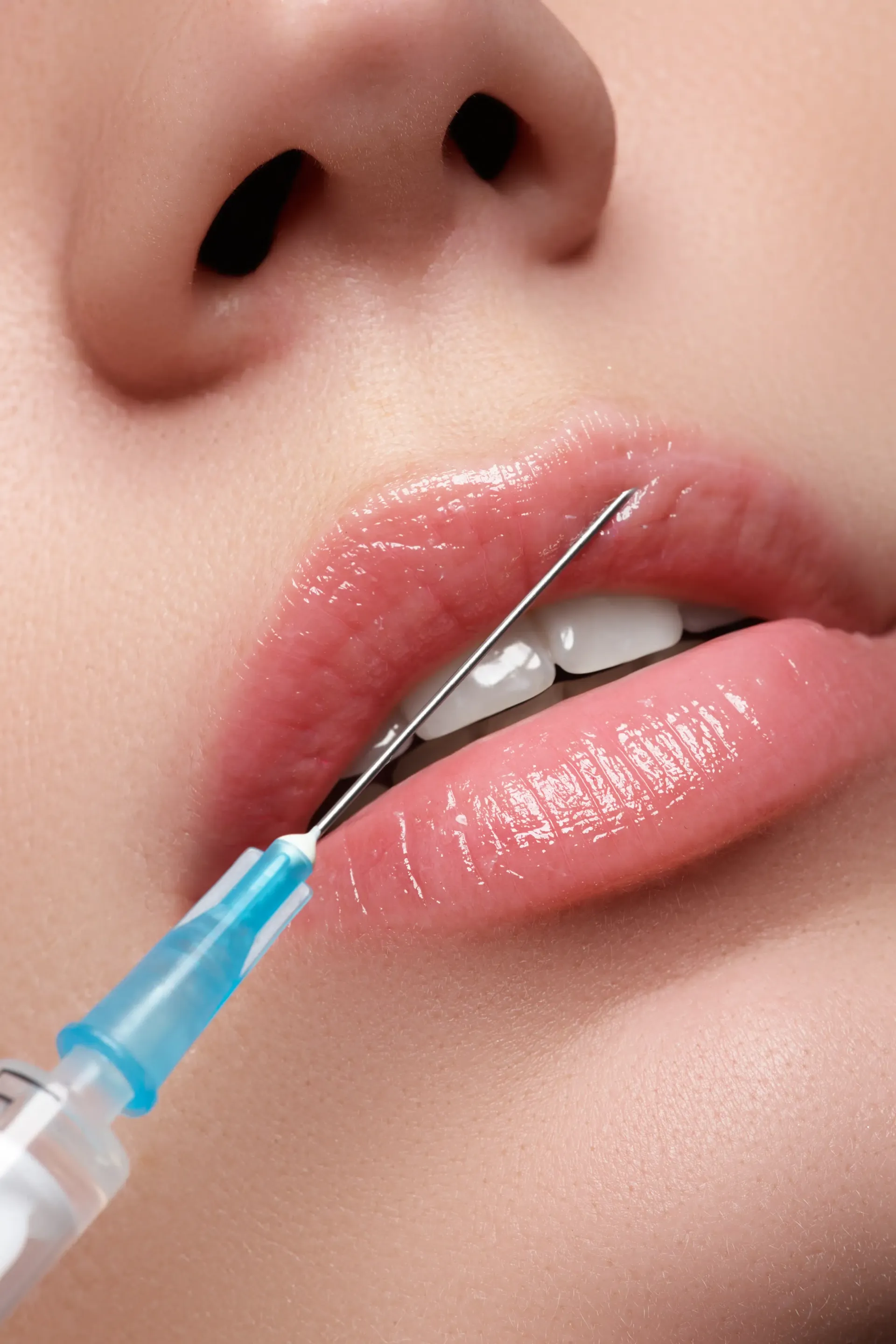 Eine Frau bekommt eine Botox-Injektion in die Lippen.