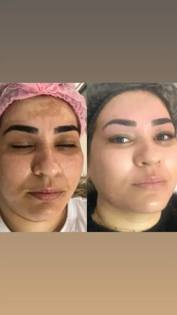 Ein Vorher-Nachher-Bild des Gesichts einer Frau.