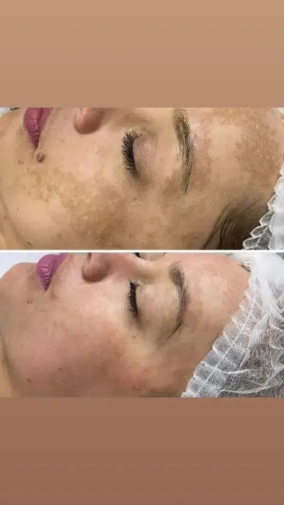 Ein Vorher-Nachher-Bild des Gesichts einer Frau.