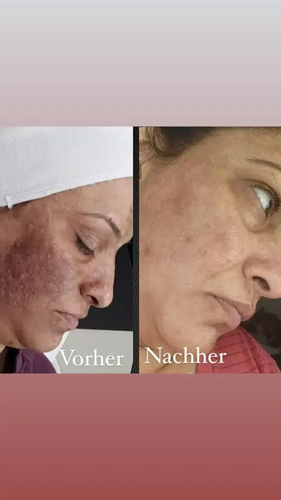 Ein Vorher-Nachher-Bild des Gesichts einer Frau.