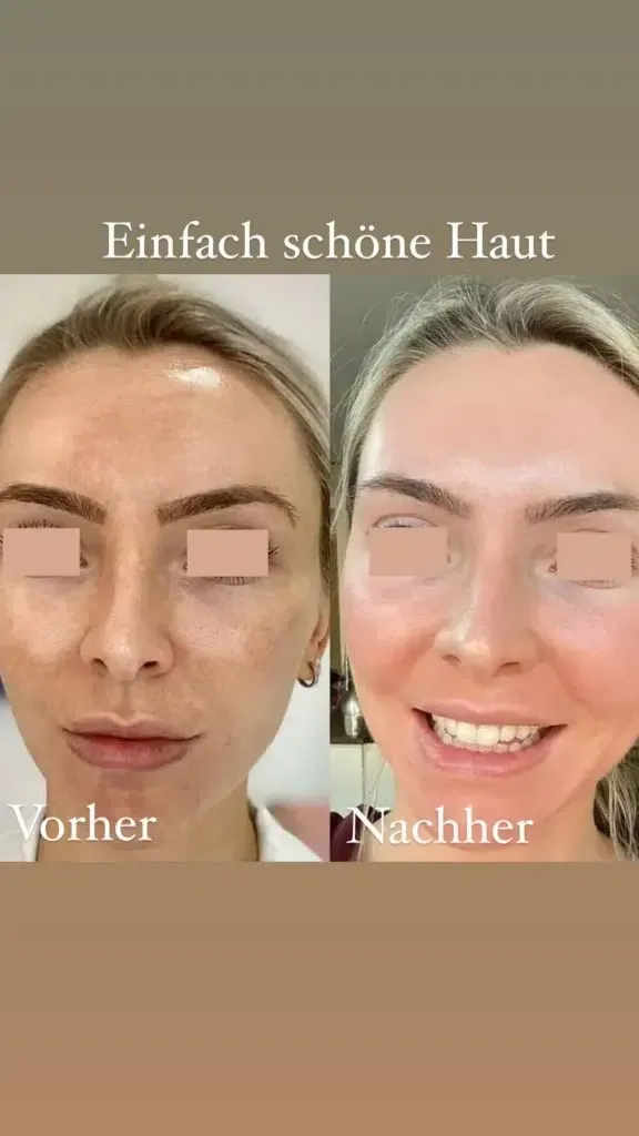 Ein Vorher-Nachher-Foto vom Gesicht einer Frau.