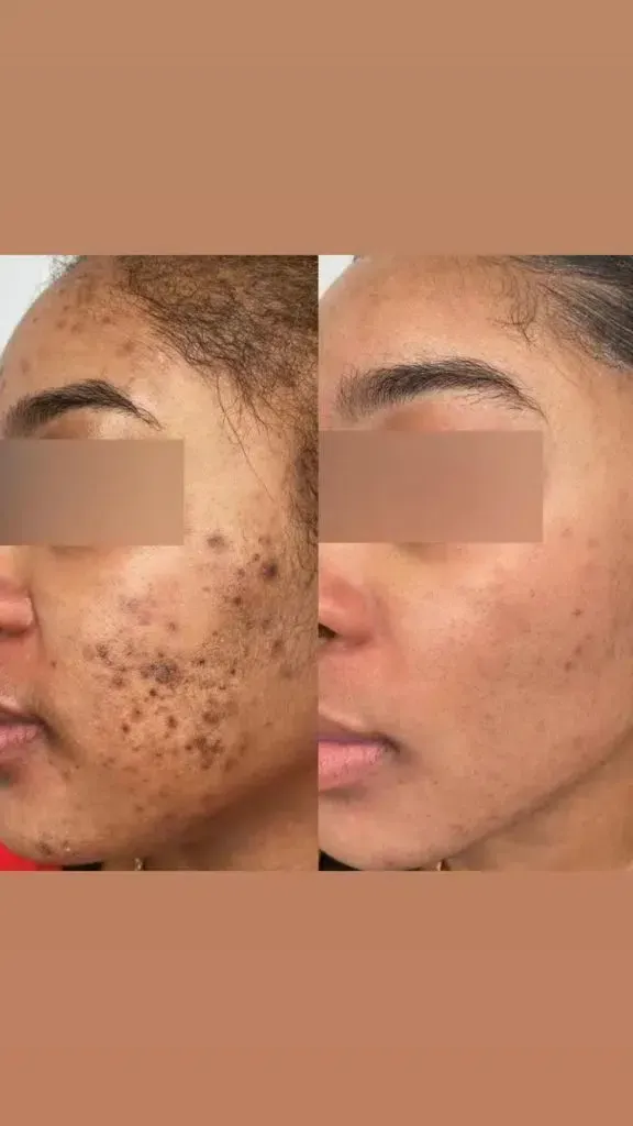 Ein Vorher-Nachher-Bild des Gesichts einer Frau mit Akne.