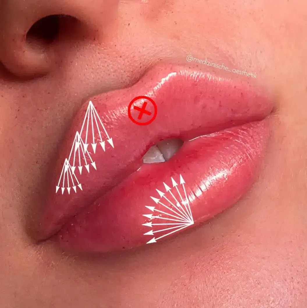 Eine Nahaufnahme der Lippen einer Frau mit darauf zeigenden Pfeilen.