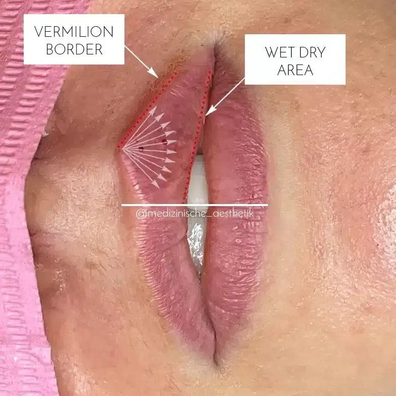 Eine Nahaufnahme der Lippen einer Frau mit Pfeilen, die auf den feuchten, trockenen Bereich zeigen.