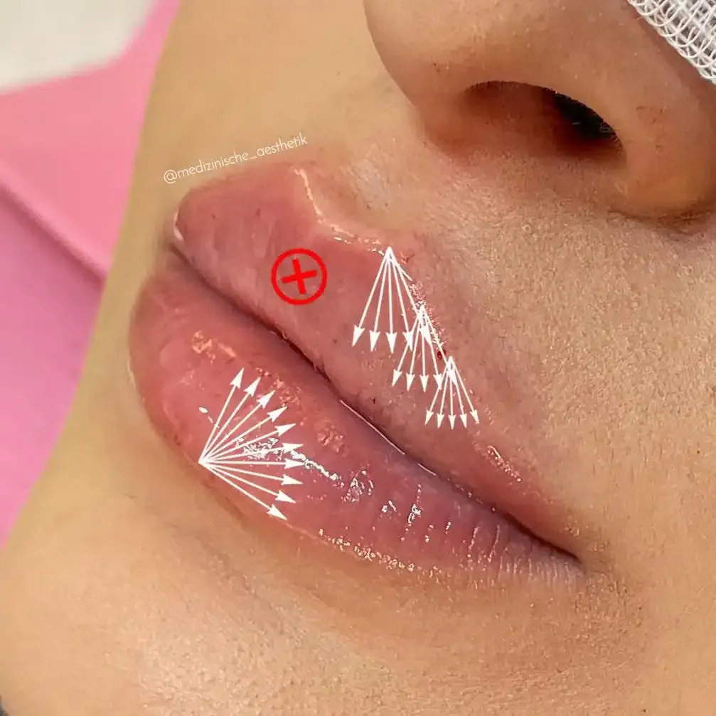 Eine Nahaufnahme der Lippen einer Frau mit darauf zeigenden Pfeilen.