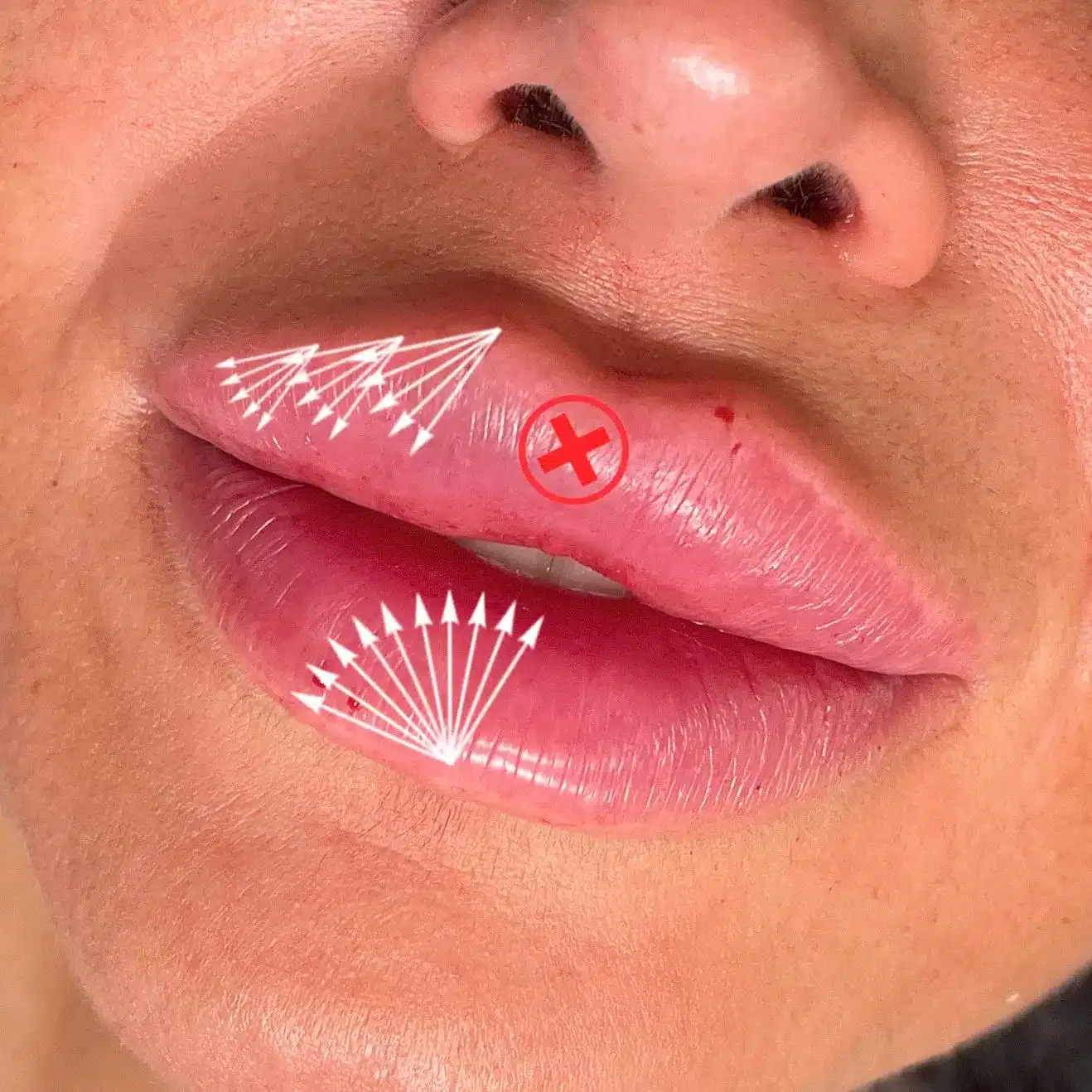 Eine Nahaufnahme der Lippen einer Frau mit darauf zeigenden Pfeilen.