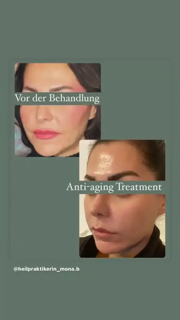 Ein Vorher-Nachher-Foto vom Gesicht einer Frau.