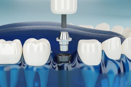 A woman is sitting in a dental chair while a dentist examines her teeth.
