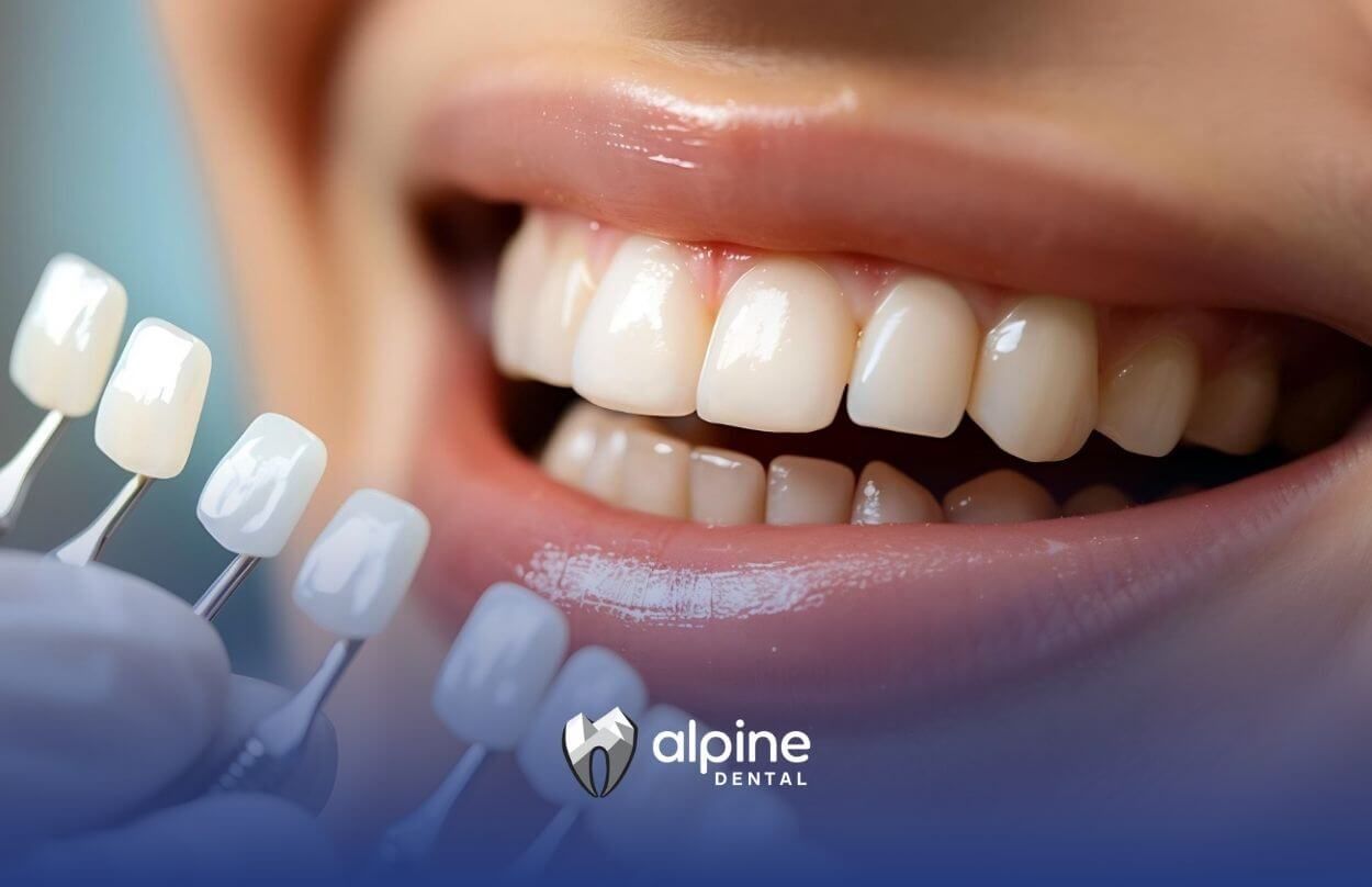 Close-up of porcelain veneers shade guide against natural teeth.