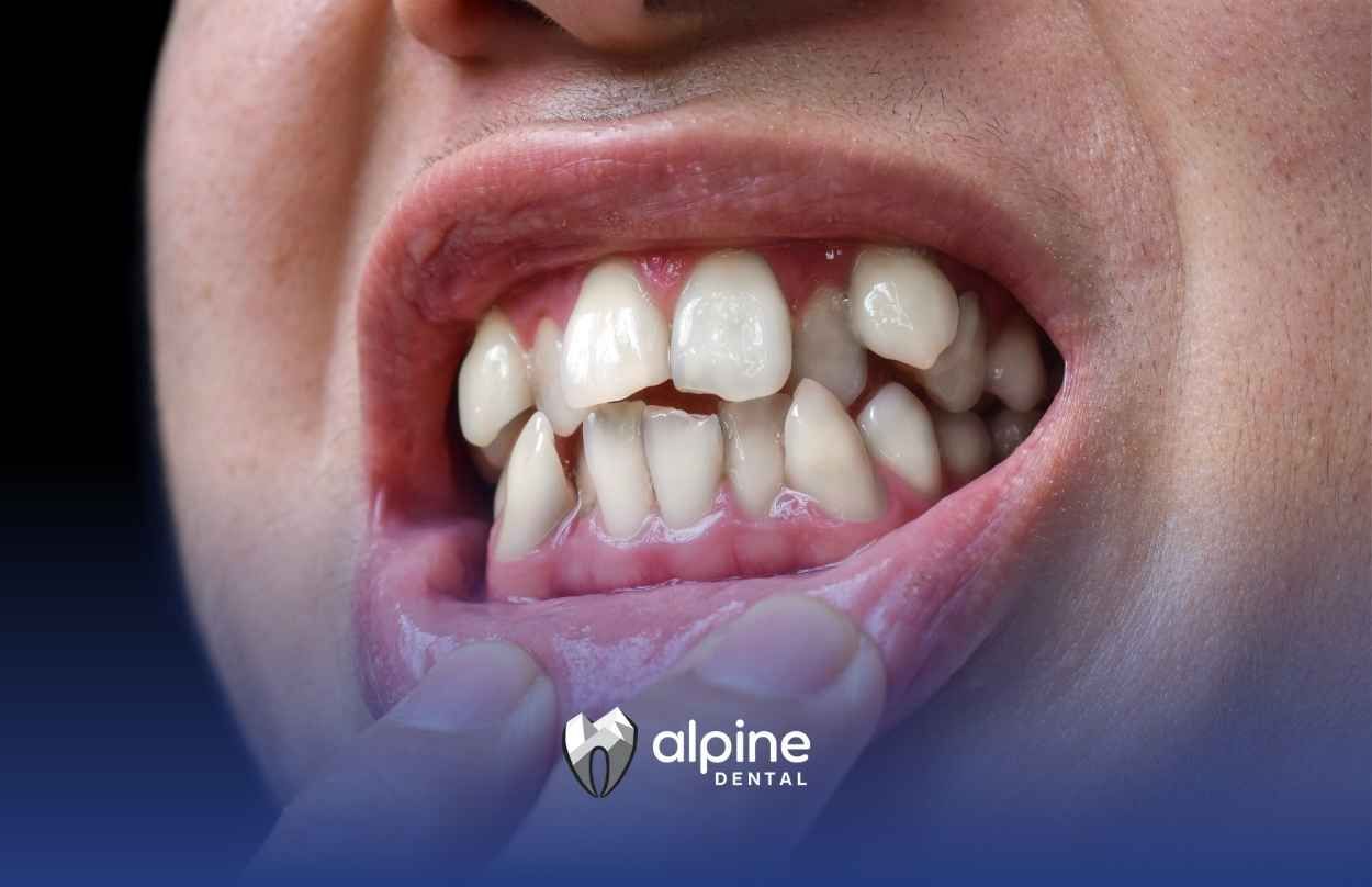 A close-up of a person's mouth showing their teeth.