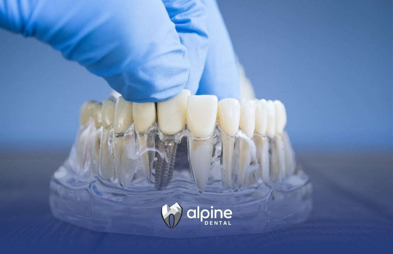 Gloved hand placing a dental implant crown on a jaw model.