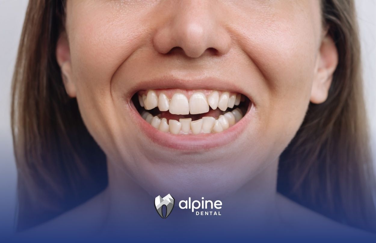 A woman smiling with crowded and misaligned front teeth needing a restorative dental treatment.