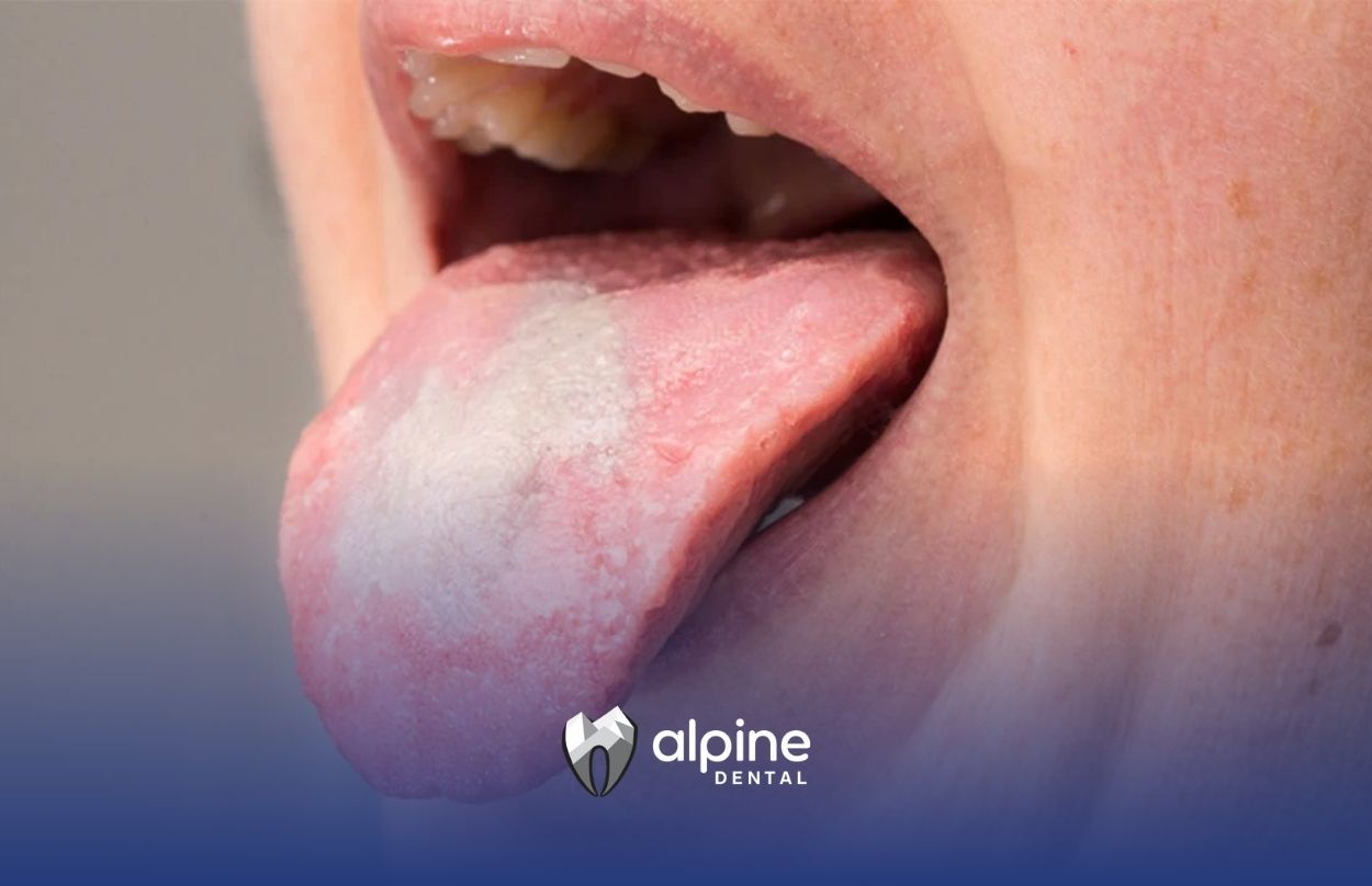 Person sticking out tongue with visible white coating from an oral yeast infection at a clinic in NJ