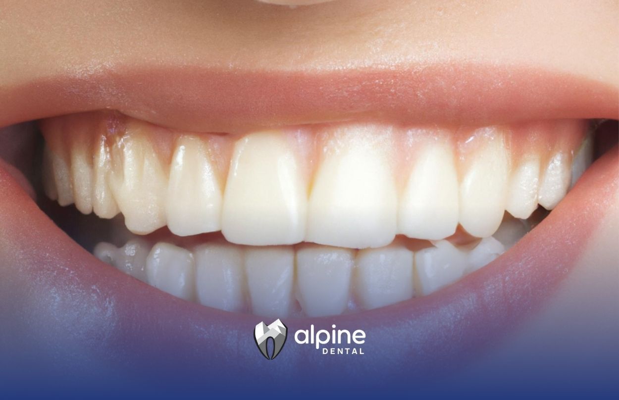 Close-up of a bright, healthy smile with white and clean teeth after dental treatment in New Jersey.