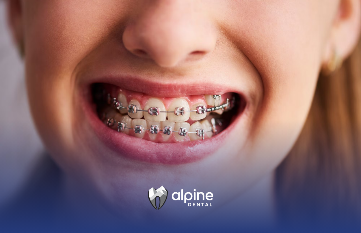 A close up of a woman 's mouth with braces on her teeth.