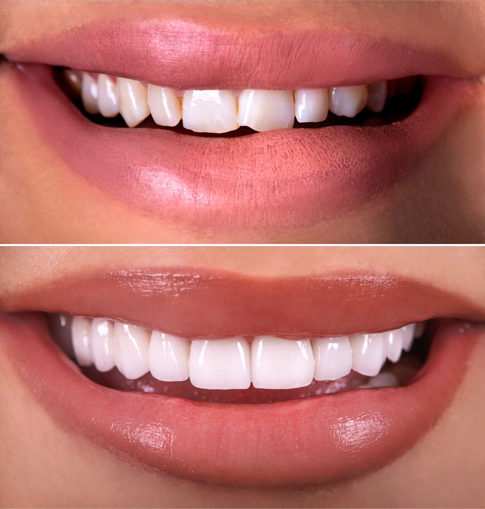 Close-up of before and after chipped tooth repair by a restorative dentist. Close-up of before and after chipped tooth repair by a restorative dentist.