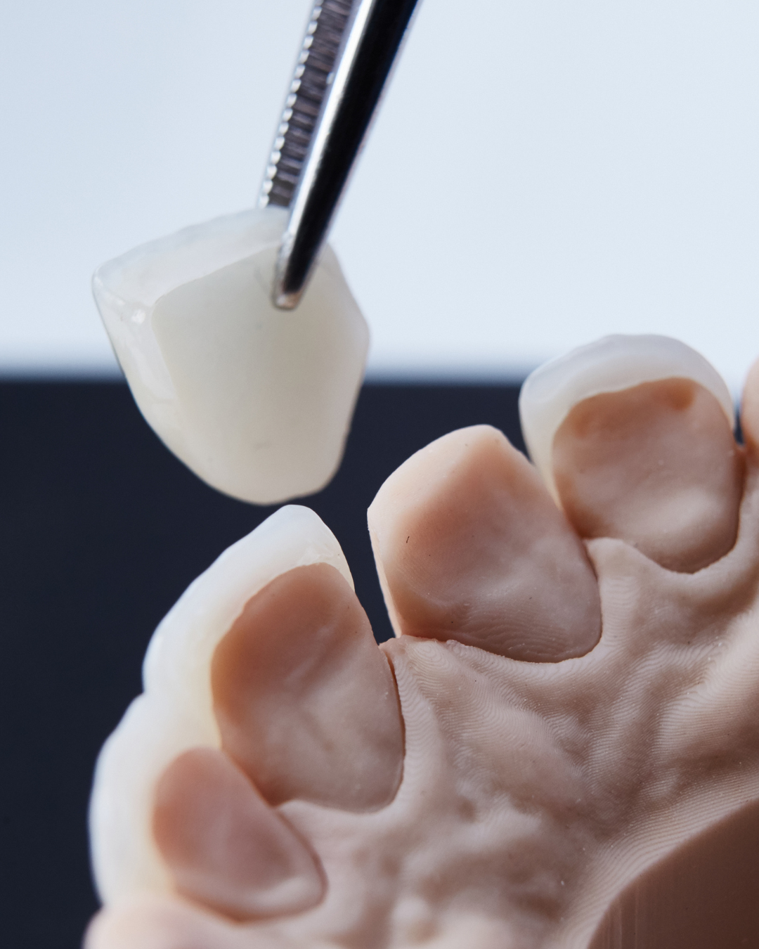 Dental veneer held by tweezers, being placed onto prepared teeth model.