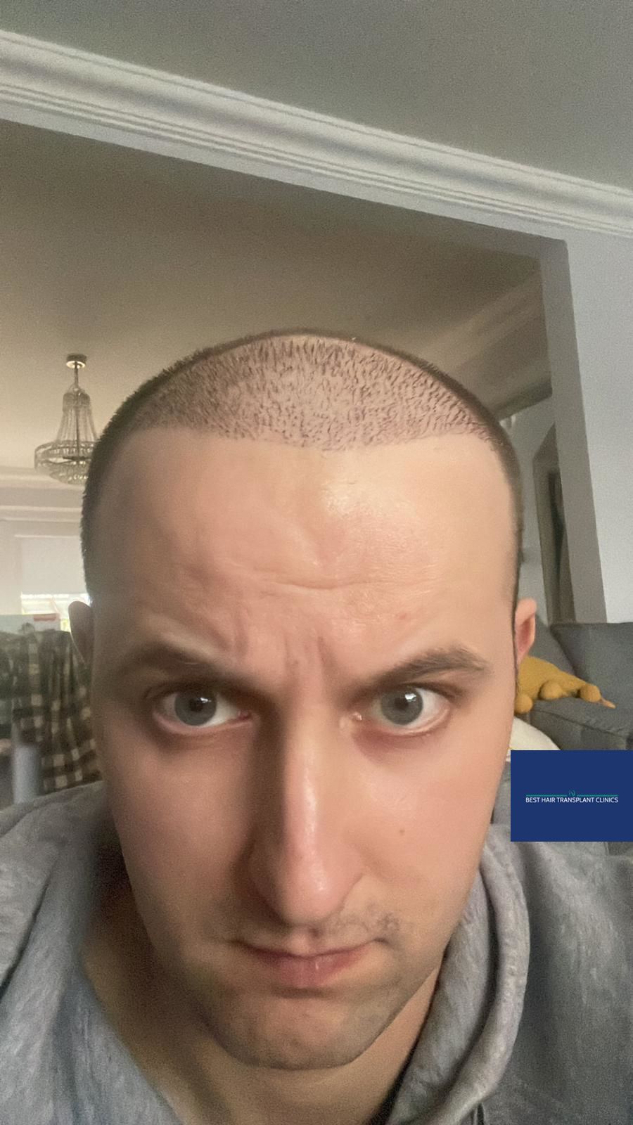 A picture of a male patient 3 months after a hair transplant procedure with hair transplants Manchester