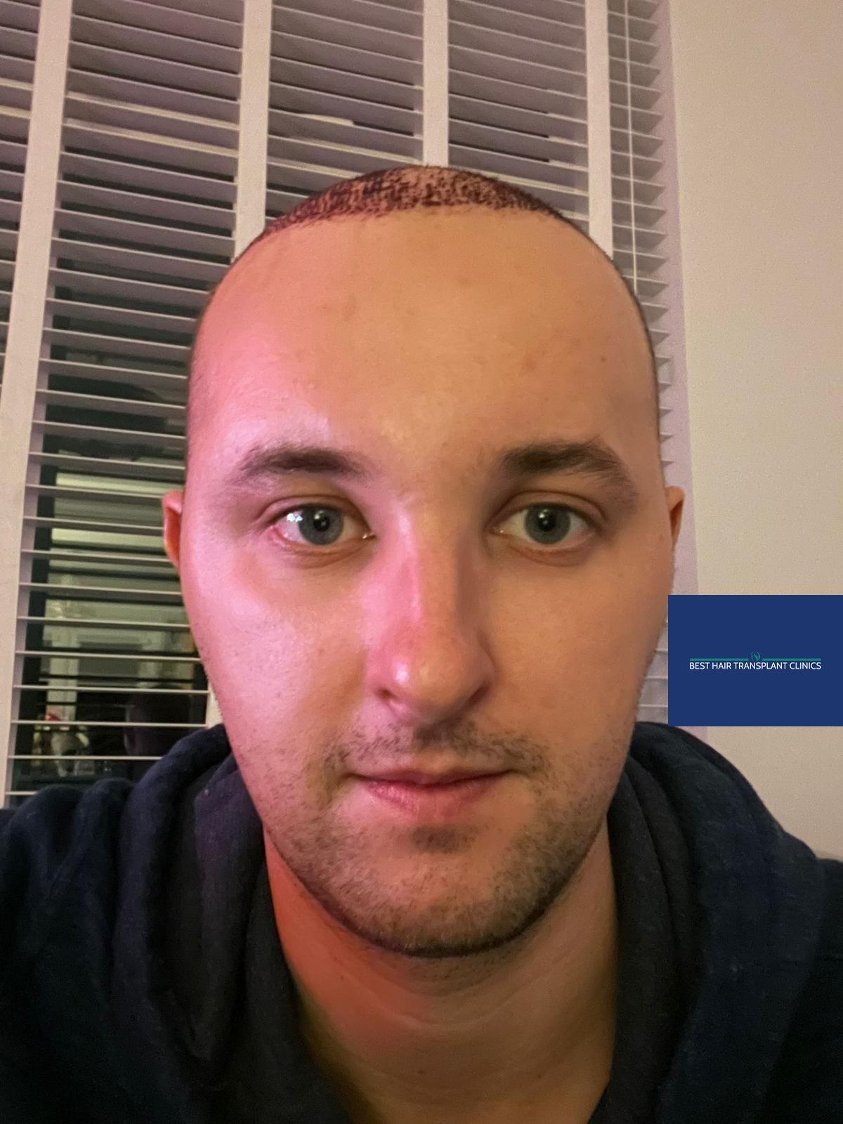 A picture of a male patient 3 days after a hair transplant procedure with hair transplants Manchester