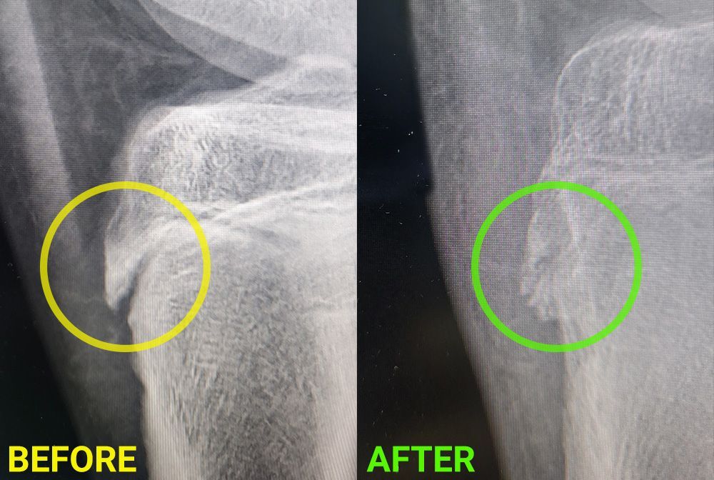 X-ray comparison showing a bone fracture. Before (yellow circle) and after (green circle) treatment.