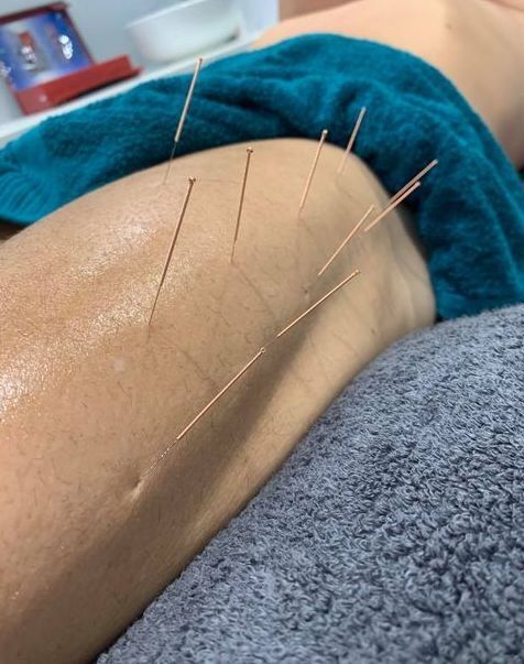 Needle On Skin  - Dry Needling In Yeppoon, QLD