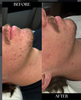 acne facial
