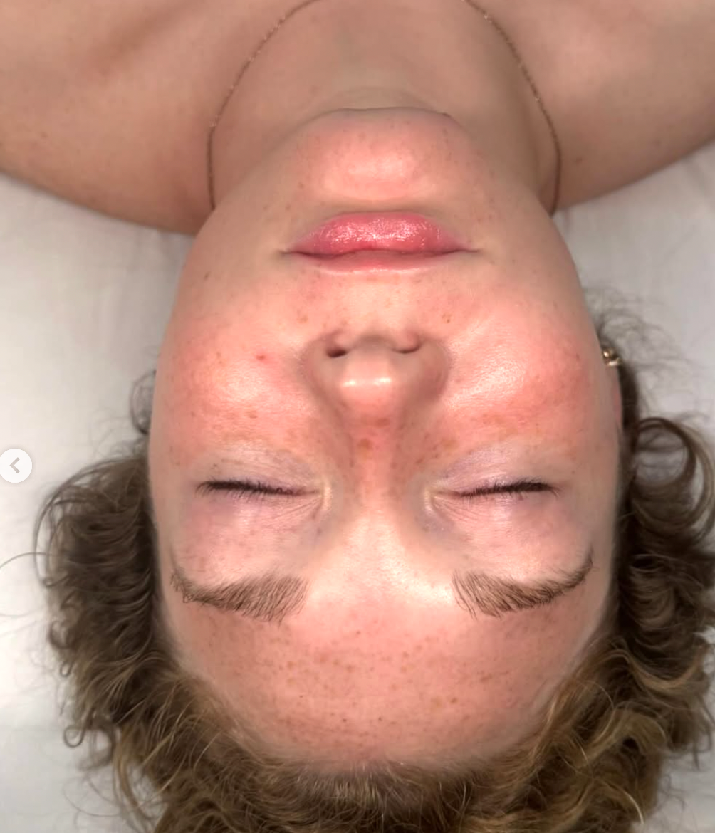acne facial