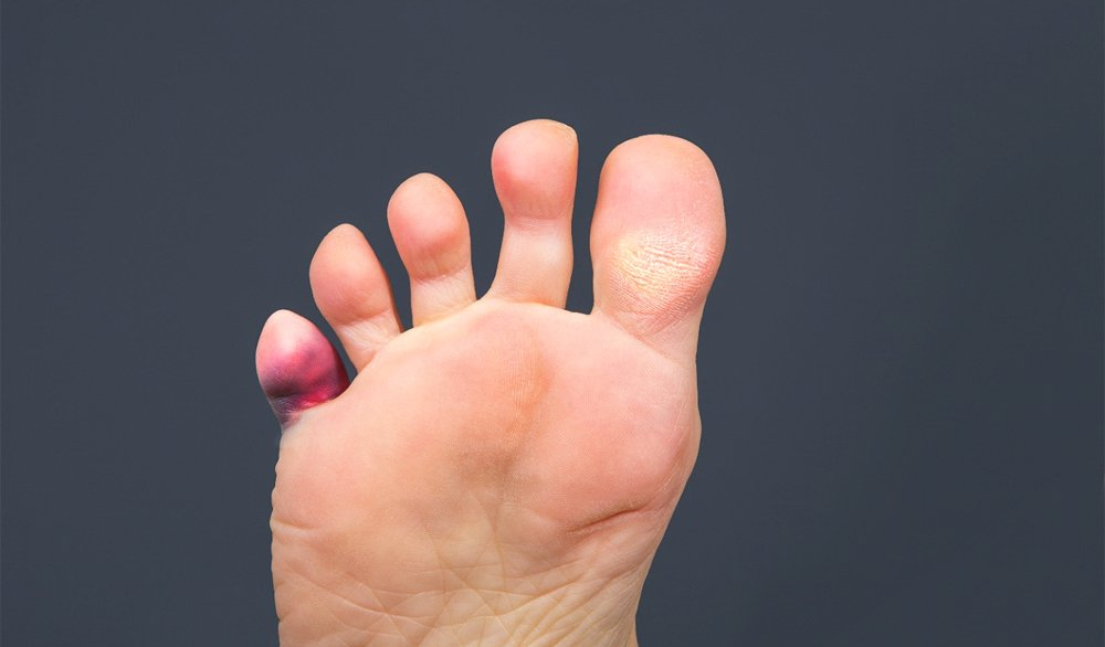 frequently-asked-questions-about-hammertoe