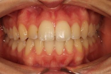 Ortodonzia fissa