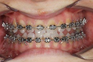 Ortodonzia e maxillo