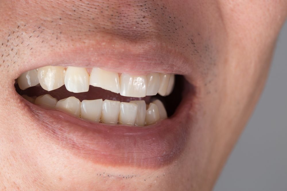 Close-up of a person's mouth, showing a chipped front tooth. The person's lips are slightly parted.
