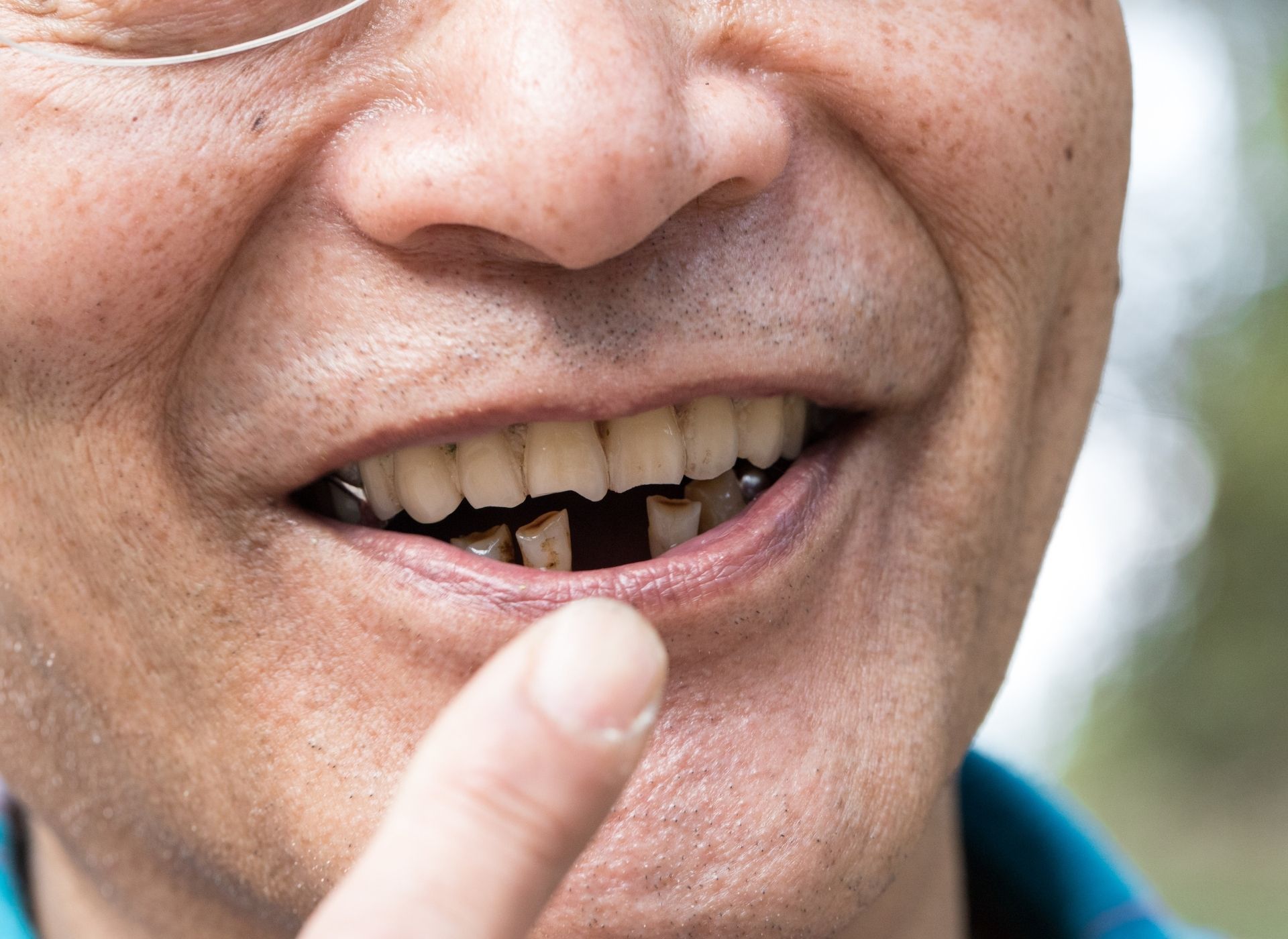 Close-up of a smiling person with missing teeth, finger pointing towards the gap.