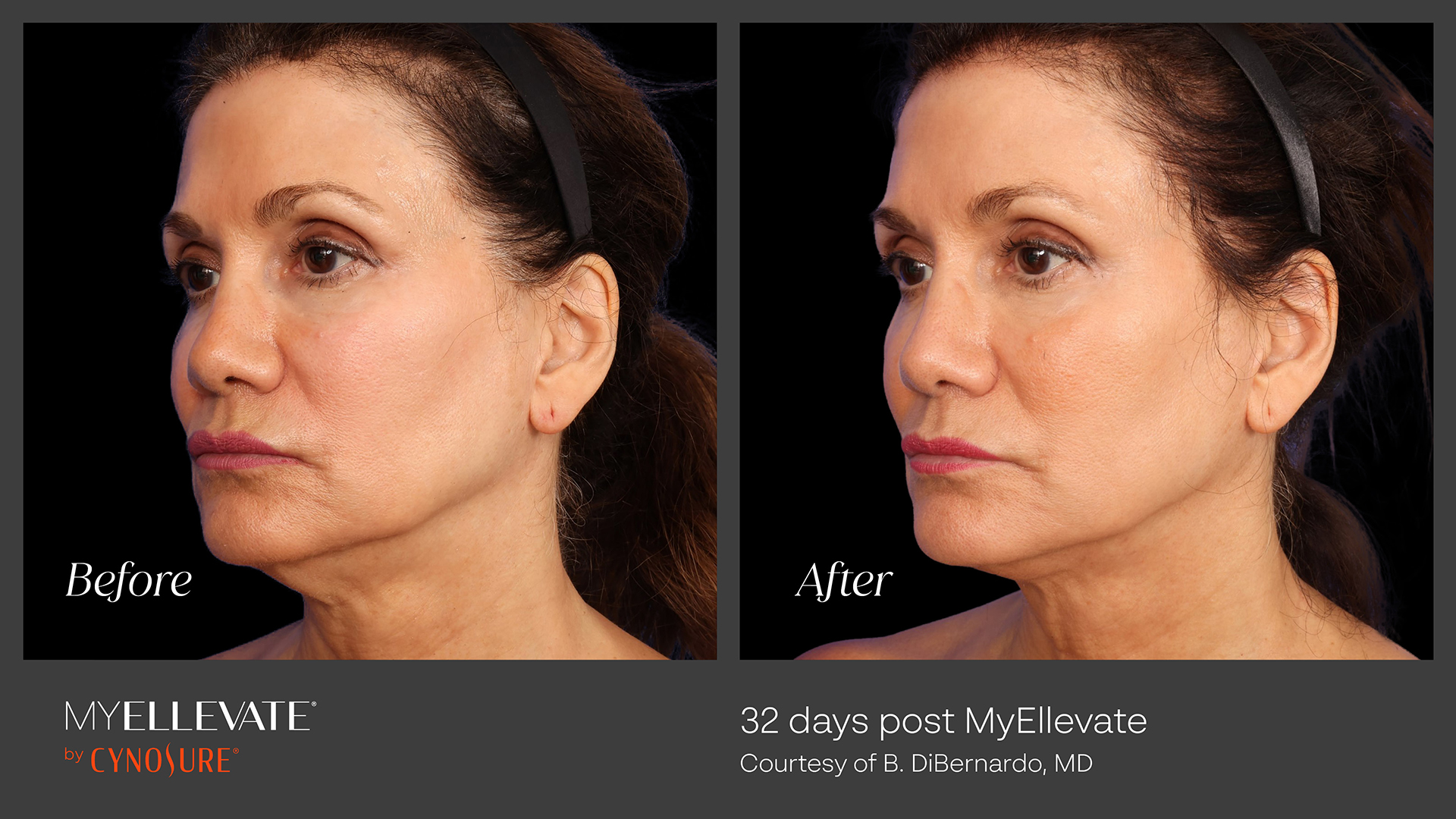 before and after MyEllevate Procedure