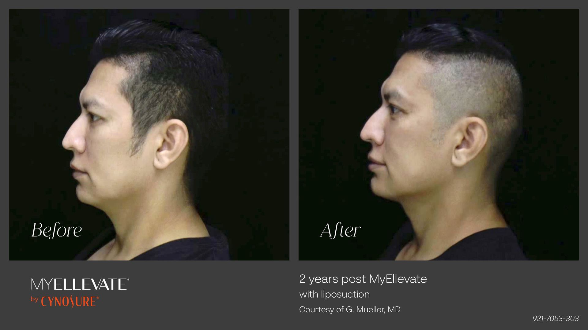 before and after MyEllevate Procedure